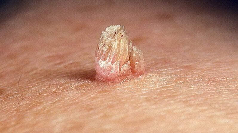 genital papilloma on the body