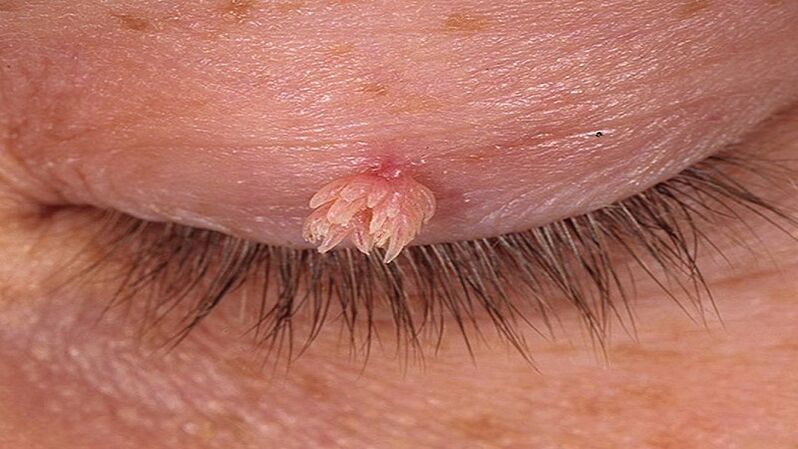 papilloma on the eyelids