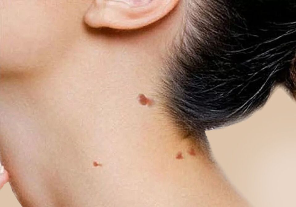 Appearance of papilloma on the neck after activation of HPV in the body