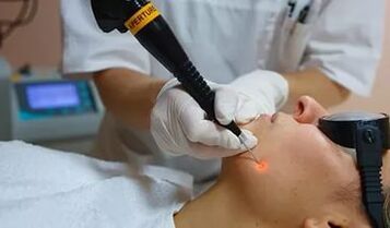 An effective procedure for removing papillomas on the face with a laser