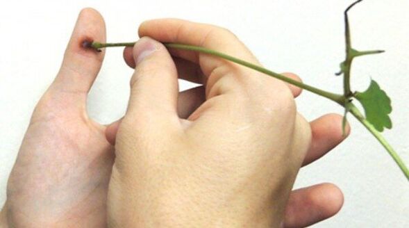 Cauterization of papillomas on the fingers with celandine juice