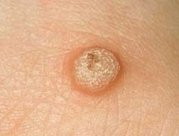 warts vulgaris on the skin