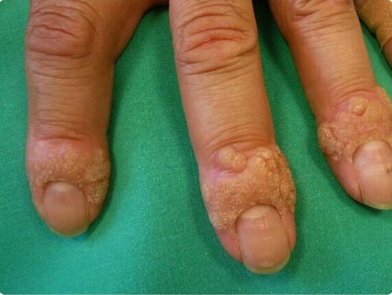 how to get rid of warts on the fingers