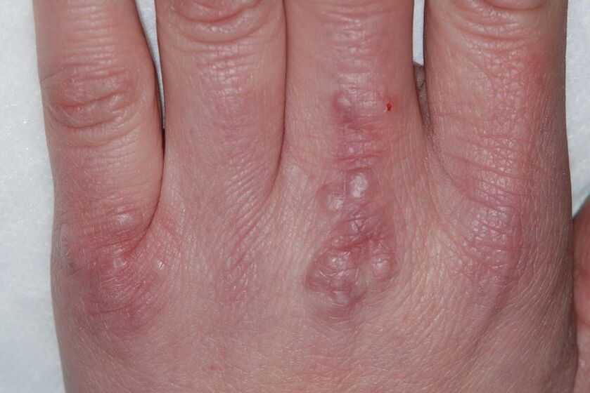 warts on the hands