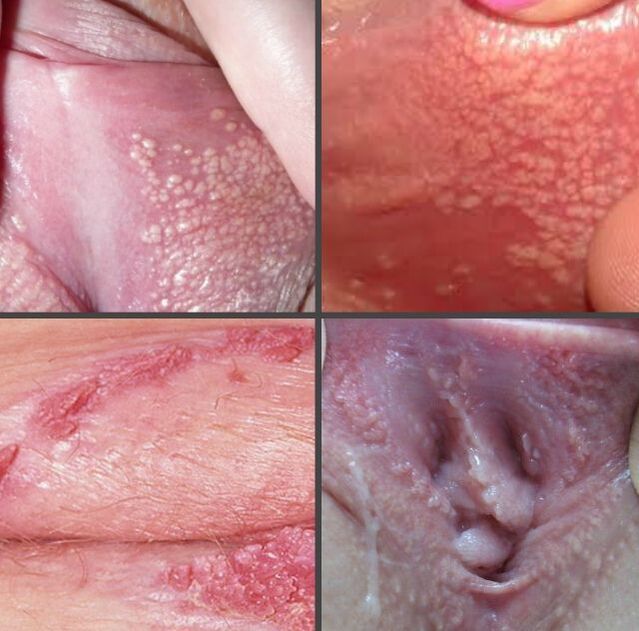 What does a papilloma on the labia look like 