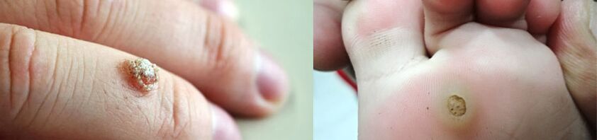 Finger warts and plantar warts