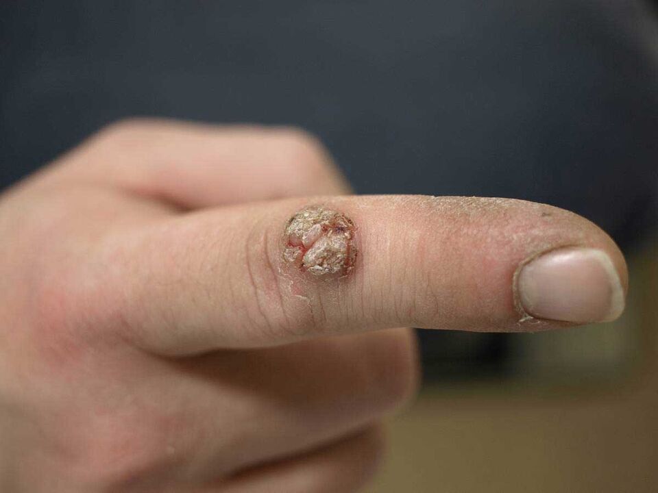 Large warts on fingers that require removal