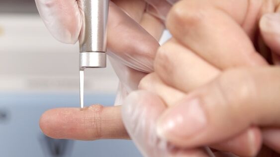 One of the methods to get rid of warts is the use of lasers