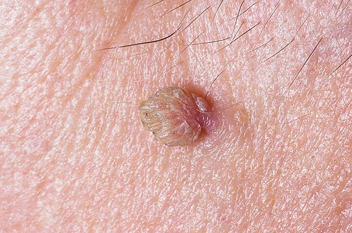 Warts on the skin that can be removed in various ways