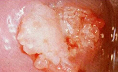 Cervical candoid
