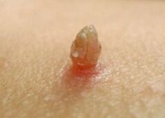 Sharp papilloma