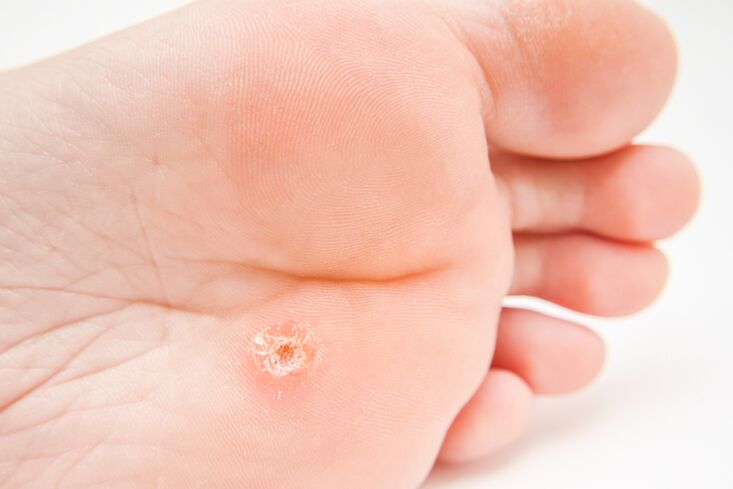 Single warts