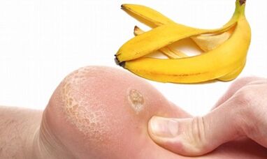 Banana skin for the treatment of plantar warts