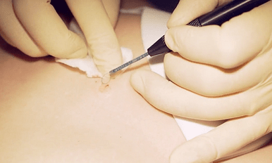 Plantar wart surgery surgery