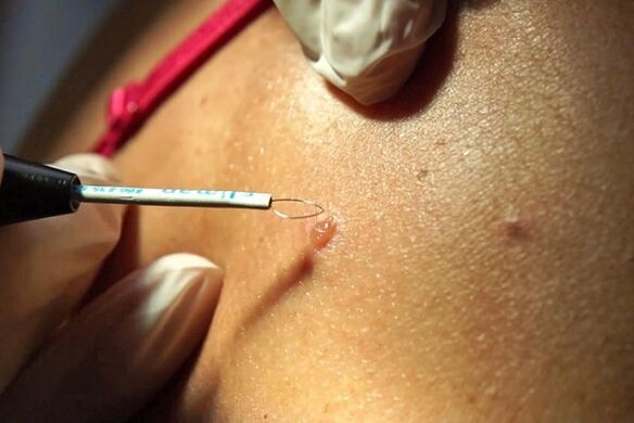 Papilloma removal using radio wave method