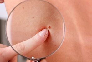 the reason for the appearance of papillomas in the human body