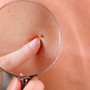 Is it possible to remove papilloma