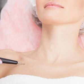 papilloma laser removal