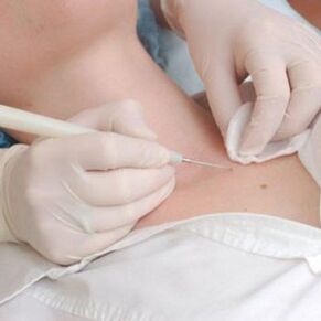 papilloma treatment in men