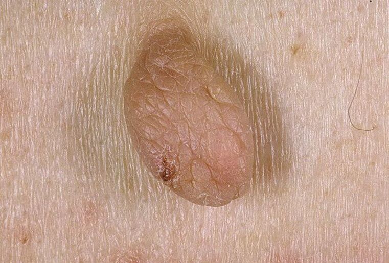 What do warts and papillomas look like