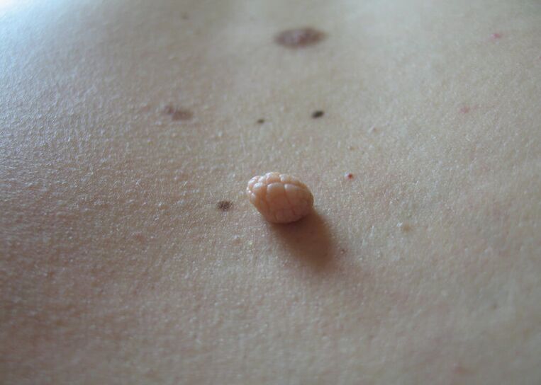 papilloma on the human body