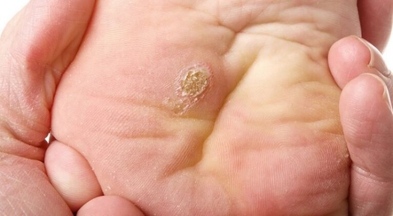 plantar and flat papilloma