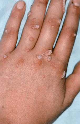 Papilloma on the hand