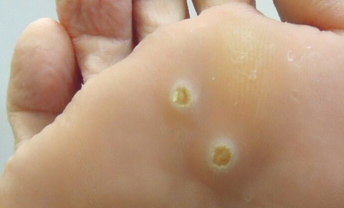 plantar papilloma on the feet