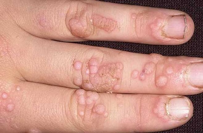 simple papilloma on the arm