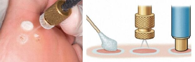 cryodestruction as a method to remove papillomas