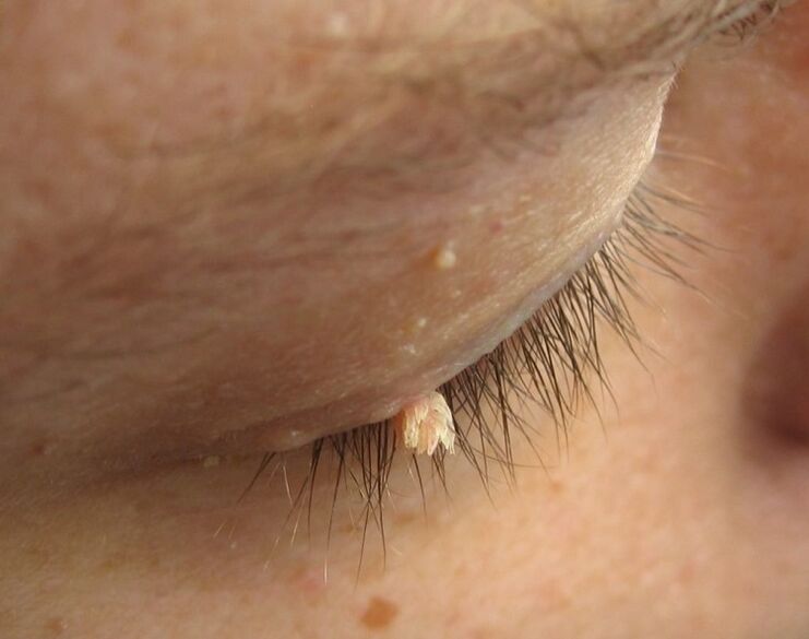 condylomas on the eyelids