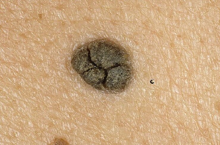 keratoma on the skin