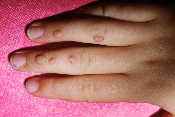 rough warts on fingers