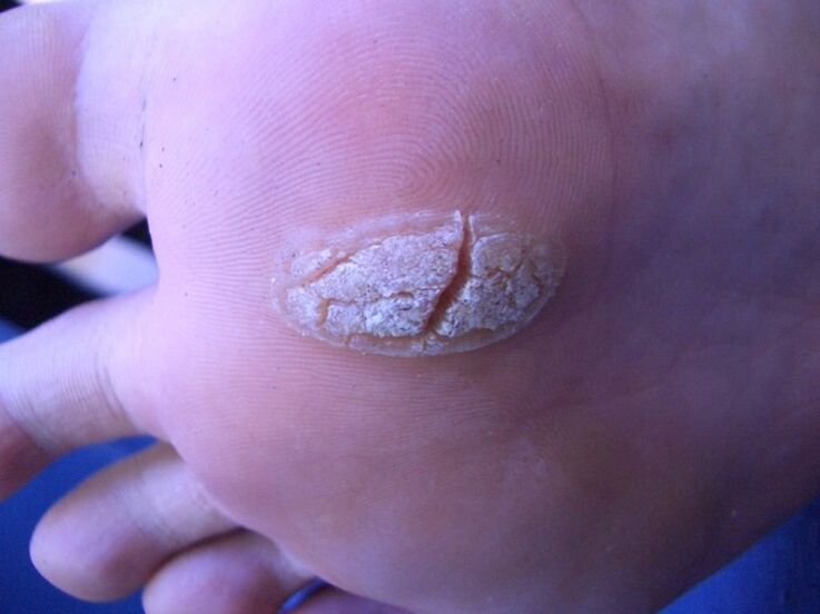 warts on the skin of the legs