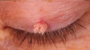 Warts pointing to the eyelids