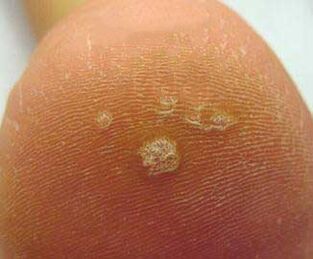 early symptoms of warts