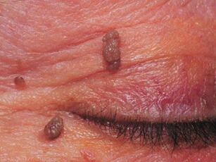Papilloma on the eyelids