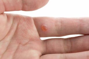 effective remedy for warts