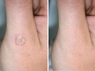 Warts before and after removal