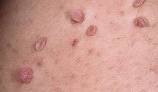 causes of the appearance of papilloma in the body