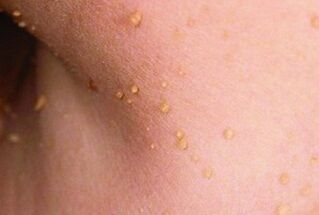 Pin on Health of the body Warts on my skin