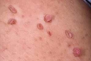 how to get rid of papilloma on the body